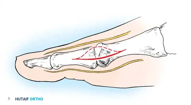 Fig. 78-13 Modiﬁ ed McBride procedure: ﬁ rst incision. Dotted line denotes dorsally curved incision; solid line indicates preferred incision (internervous plane).