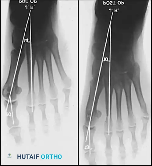 Fig. 78-12 Hallux valgus treated by modiﬁ ed McBride procedure. A, Preoperative deformity in 30-year-old patient. B, Correction obtained at surgery. C, Preoperative and postoperative radiographs (note ﬁ bular sesamoid was not removed). More deformity can be corrected by ﬁ bular sesamoidectomy, but overcorrection (hallux varus) is risk. If ﬁ bular sesamoid is excised, medial capsule should be closed while holding hallux in 5 to 10 degrees valgus and kept in that position until capsular healing.