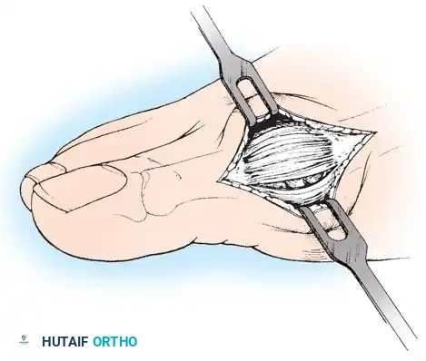 Fig. 78-14 Modiﬁ ed McBride procedure. Longitudinal capsular incision is 3 to 4  mm plantar to skin incision.