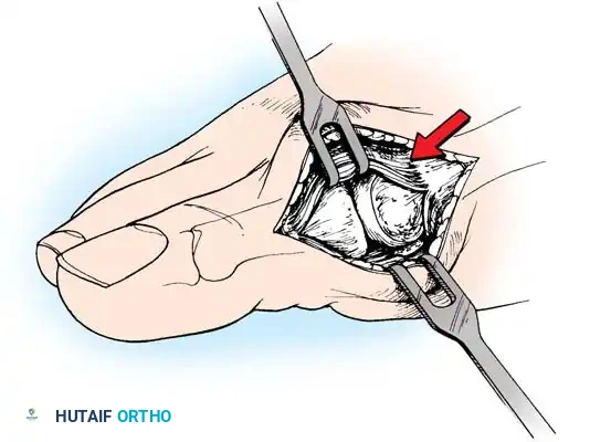 Disorders of the Hallux Surgical Diagram