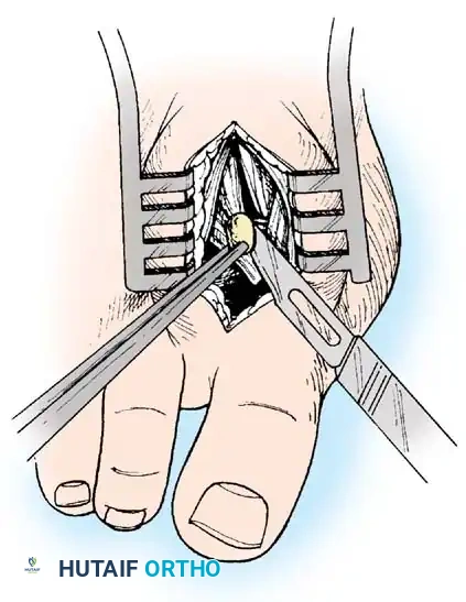 Fig. 78-20 Modiﬁ ed McBride procedure. Fibular sesamoid is removed.