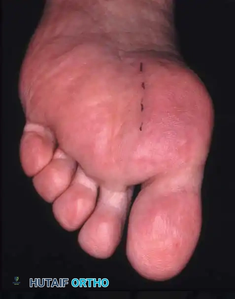 Fig. 78-21 Fibular sesamoidectomy (plantar approach). A, Incision. B, Common digital nerve to ﬁ rst web space.