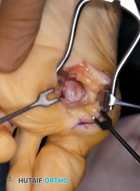 Fig. 78-21 Fibular sesamoidectomy (plantar approach). A, Incision. B, Common digital nerve to ﬁ rst web space.