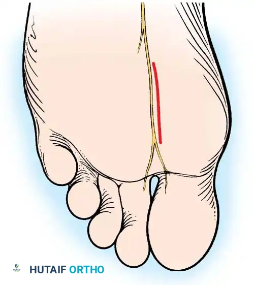 Fig. 78-21 Fibular sesamoidectomy (plantar approach). A, Incision. B, Common digital nerve to ﬁ rst web space.