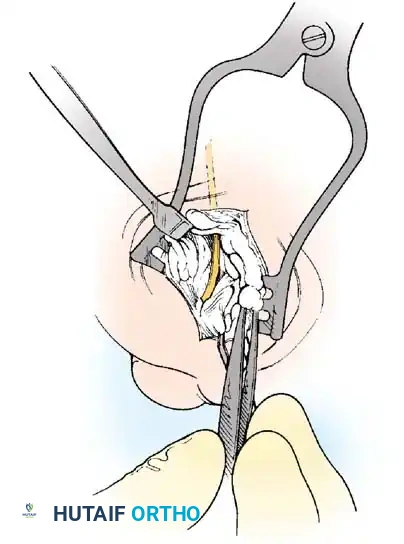 Fig. 78-21 Fibular sesamoidectomy (plantar approach). A, Incision. B, Common digital nerve to ﬁ rst web space.