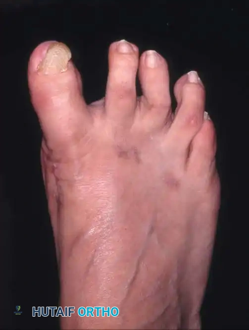 Fig. 78-22 Modiﬁ ed McBride procedure. Medial capsule is imbricated, with plantar ﬂ ap over dorsal ﬂ ap. Inset, Cross section through metatarsal head.