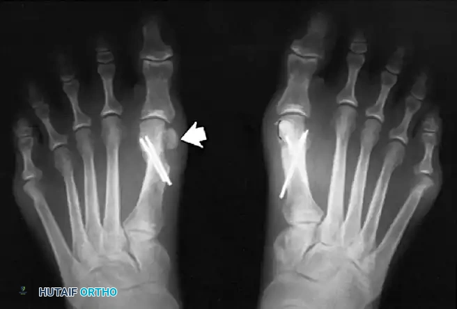 Fig. 78-22 Modiﬁ ed McBride procedure. Medial capsule is imbricated, with plantar ﬂ ap over dorsal ﬂ ap. Inset, Cross section through metatarsal head.