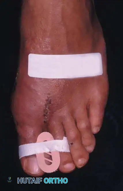 Fig. 78-25 Toe spacer is worn for 6 weeks after surgery to maintain medial capsular stabilization.