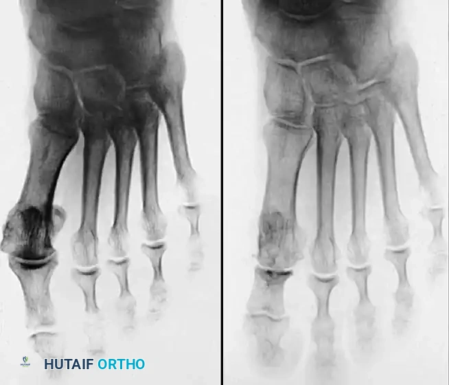 Disorders of the Hallux Surgical Diagram