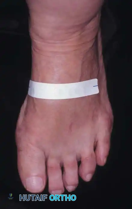 Fig. 78-29 Severe hallux valgus with bursa formation in 70-year-old woman. A and B, Anteroposterior and lateral clinical photographs of patient’s right foot. C, Correction of deformity by modiﬁ ed Keller procedure. D, Preoperative and postoperative weight bearing radiographs of same patient.