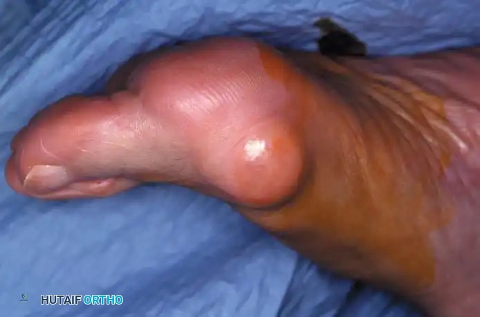 Disorders of the Hallux Surgical Diagram