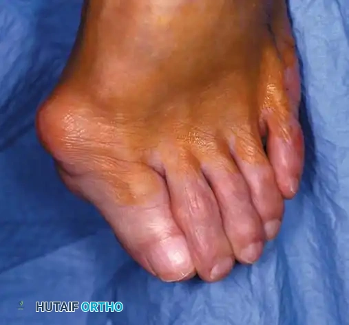 Disorders of the Hallux Surgical Diagram