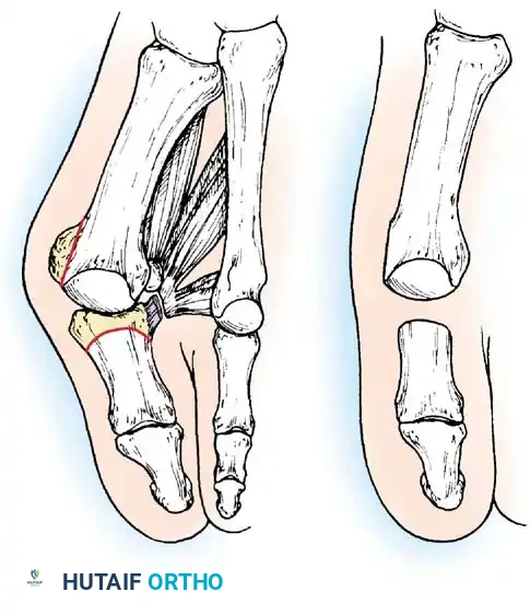 Disorders of the Hallux Surgical Diagram