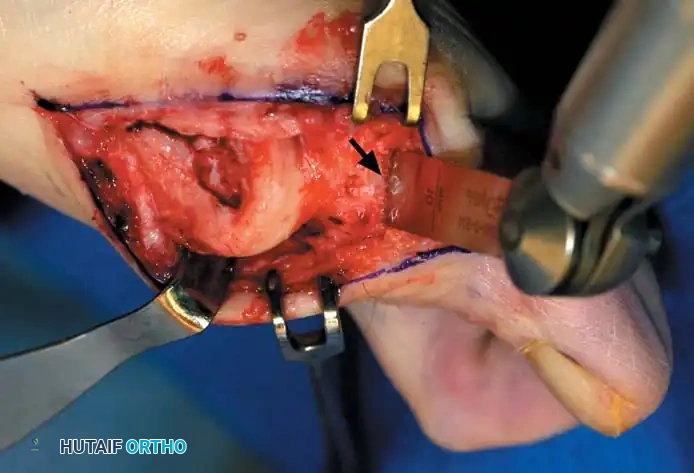 Disorders of the Hallux Surgical Diagram