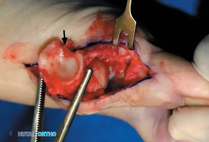 Fig. 78-30 Keller technique. A, Re section of proximal phalanx, release of adductor tendon, and resection of medial eminence. B, Metaphyseal-diaphyseal junction of proximal phalanx (arrow) . C, Note concave plantar aspect of proximal phalanx for course of ﬂ exor hallucis longus tendon (arrow) .