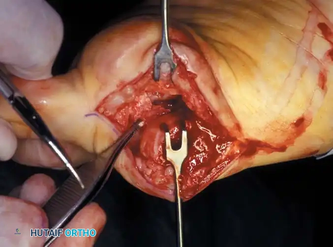 Flexor hallucis longus