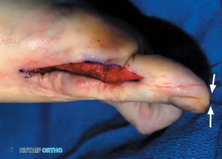 Fig. 78-31, cont’d F, Two 0.062-inch Kirschner wires are drilled distally. G, First metatarsal head is manually displaced laterally, and hallux is placed end-on the ﬁ rst metatarsal. Kirschner wires are drilled proximally across joint. H, Capsule is mobilized dorsally and plantarward. I, 2-0 or 3-0 absorbable sutures placed in purse-string fashion are used for capsular closure. J, Capsule must be closed over joint. Note pins cut off at skin level; they also can be bent at skin level.