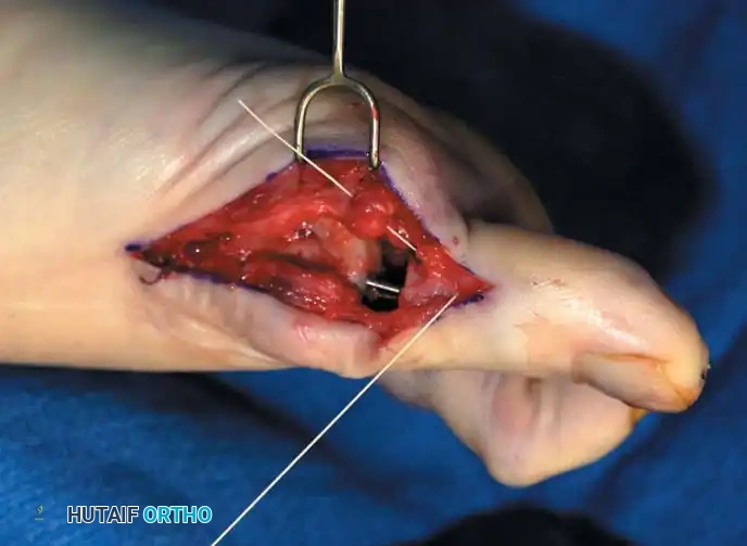 Disorders of the Hallux Surgical Diagram