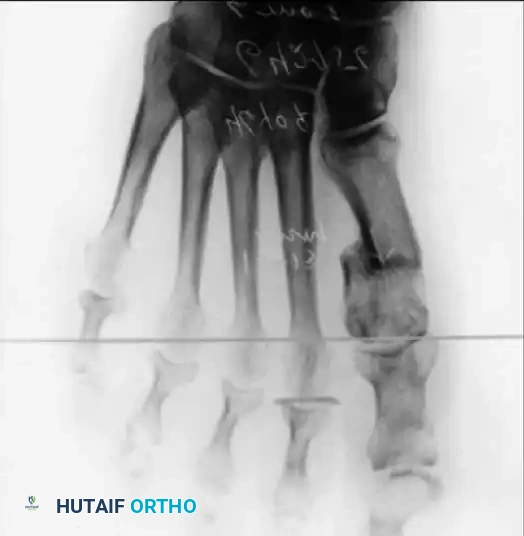 Fig. 78-33 A and B, Anteroposterior and lateral weight bearing radiographs of Mitchell procedure that, through excessive shortening and dorsally angulated malunion, has resulted in transfer metatarsalgia. This biplanar deformity is most difﬁ cult to correct.