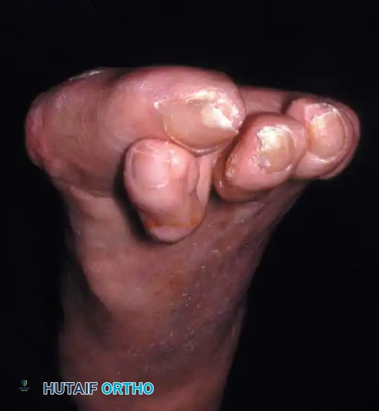 Fig. 78-36 A, This degree of deformity (left foot) is difﬁ cult to correct with standard chevron osteotomy when apex is at subchondral bone of capital fragment. B, Standing radiograph of left foot before correction. C, Standing radiograph 1 year after chevron osteotomy, release of adductor hallucis, Akin osteotomy, and correction of hammer toe.