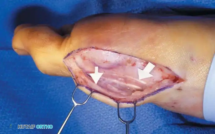 Disorders of the Hallux Surgical Diagram