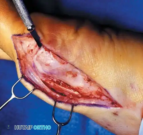 Disorders of the Hallux Surgical Diagram