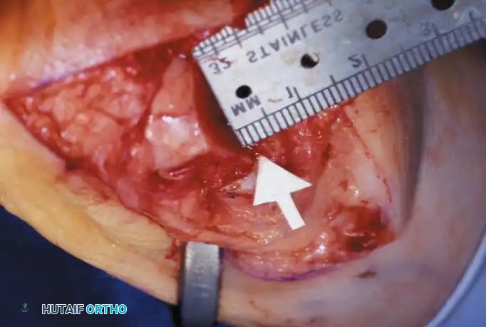 Disorders of the Hallux Surgical Diagram