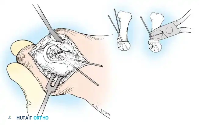 Disorders of the Hallux Surgical Diagram