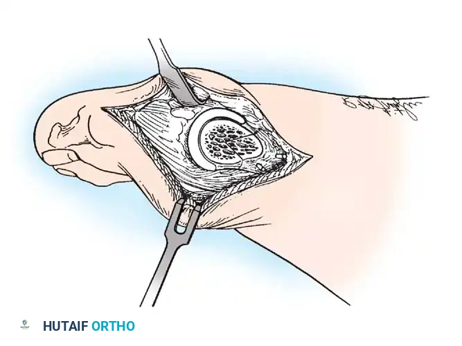 Disorders of the Hallux Surgical Diagram
