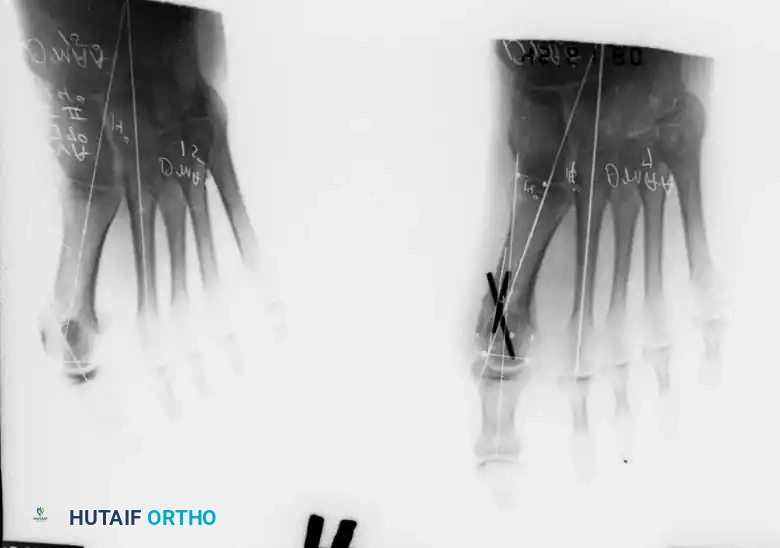 Disorders of the Hallux Surgical Diagram