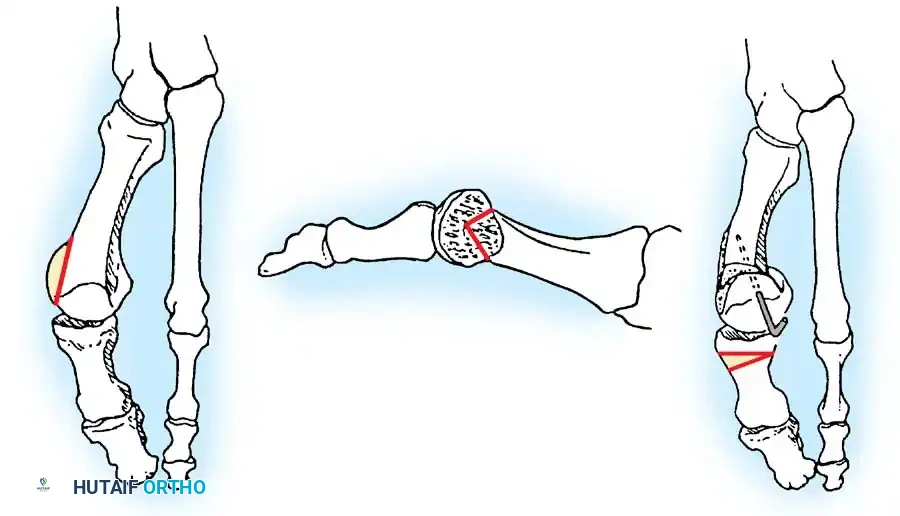 Disorders of the Hallux Surgical Diagram