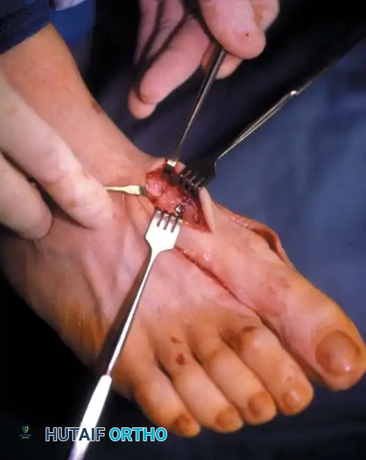 Fig. 78-41, cont’d F, Knife blade is in metatarsocuneiform joint, and two lines marked on metatarsal represent osteotomy site (proximal line) and location of screw for ﬁ xation (distal line) . G, Final position of screw and position of metatarsal after correction of ﬁ rst metatarsal. H, Note Freer elevator is displacing or rotating proximal fragment medially, whereas ﬁ rst metatarsal head and distal fragment are being angulated laterally by manual pressure. I, Postoperative dressings after correction of hallux valgus. Metatarsal heads are ﬁ rmly bound together, and great toe is rotated to keep sesamoids aligned beneath metatarsal head. Right toe should be dressed in counterclockwise direction and left toe in clockwise direction when standing at foot of bed. ( A-D from Mann RA, Coughlin MJ: The video textbook of foot and ankle surgery , St Louis, 1991, Medical Video Productions; E and I from Mann RA, Coughlin MJ, eds: Surgery of the foot and ankle , 6th ed, St Louis, 1993, Mosby.)