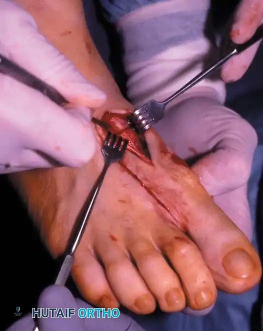 Fig. 78-41, cont’d F, Knife blade is in metatarsocuneiform joint, and two lines marked on metatarsal represent osteotomy site (proximal line) and location of screw for ﬁ xation (distal line) . G, Final position of screw and position of metatarsal after correction of ﬁ rst metatarsal. H, Note Freer elevator is displacing or rotating proximal fragment medially, whereas ﬁ rst metatarsal head and distal fragment are being angulated laterally by manual pressure. I, Postoperative dressings after correction of hallux valgus. Metatarsal heads are ﬁ rmly bound together, and great toe is rotated to keep sesamoids aligned beneath metatarsal head. Right toe should be dressed in counterclockwise direction and left toe in clockwise direction when standing at foot of bed. ( A-D from Mann RA, Coughlin MJ: The video textbook of foot and ankle surgery , St Louis, 1991, Medical Video Productions; E and I from Mann RA, Coughlin MJ, eds: Surgery of the foot and ankle , 6th ed, St Louis, 1993, Mosby.)