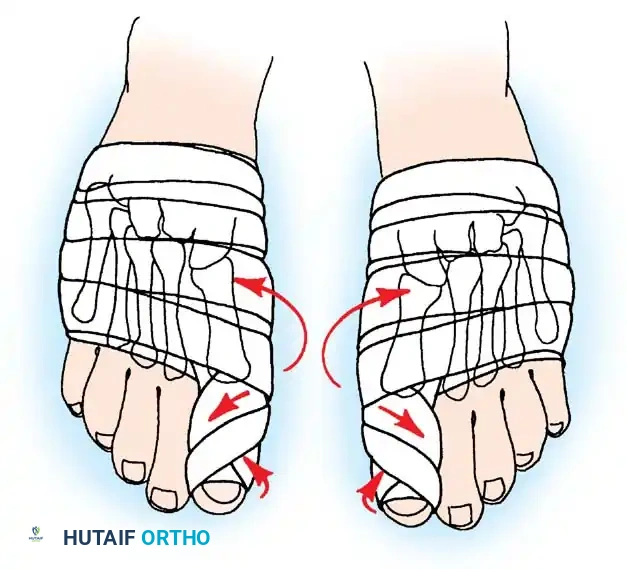 Disorders of the Hallux Surgical Diagram