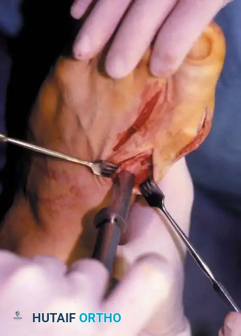 TECHNIQUE 78-8 Mann and Coughlin—cont’d