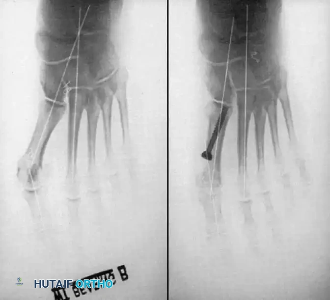 Disorders of the Hallux Surgical Diagram