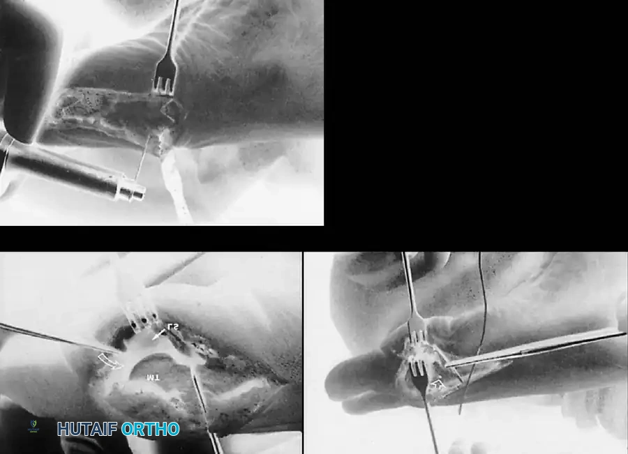 Disorders of the Hallux Surgical Diagram