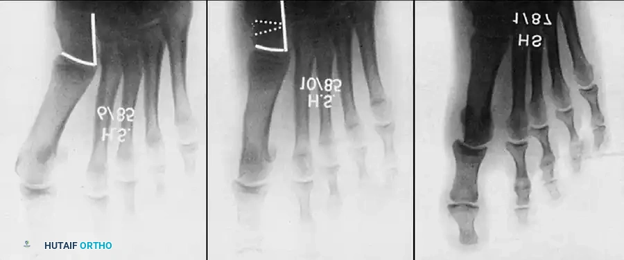 Disorders of the Hallux Surgical Diagram