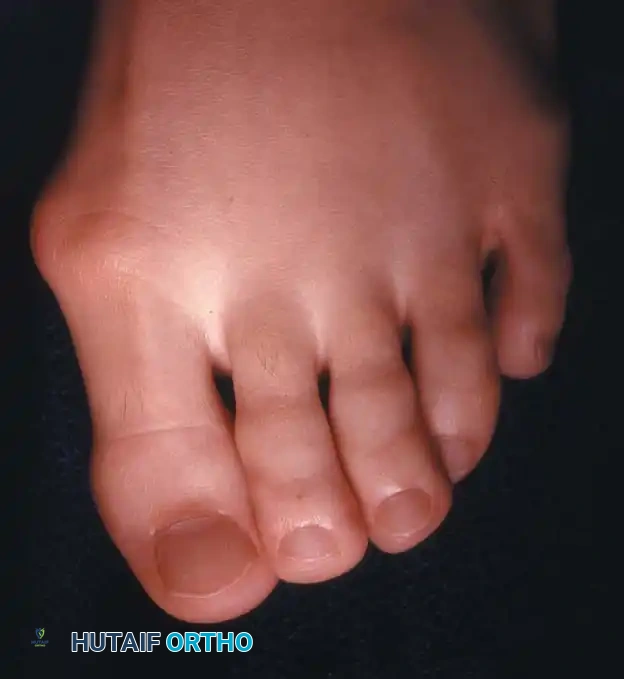 Fig. 78-51 A, Mild hallux valgus and signiﬁ cant hallux valgus interphalangeus is a deformity that can be corrected with an Akin osteotomy. B, Deformity that is not appropriate for Akin osteotomy.