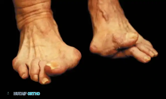 Fig. 78-54 Severe hallux valgus is good indication for arthrodesis of ﬁ rst metatarsophalangeal joint, particularly in recurrent hallux valgus after previous attempt at correction (left foot).