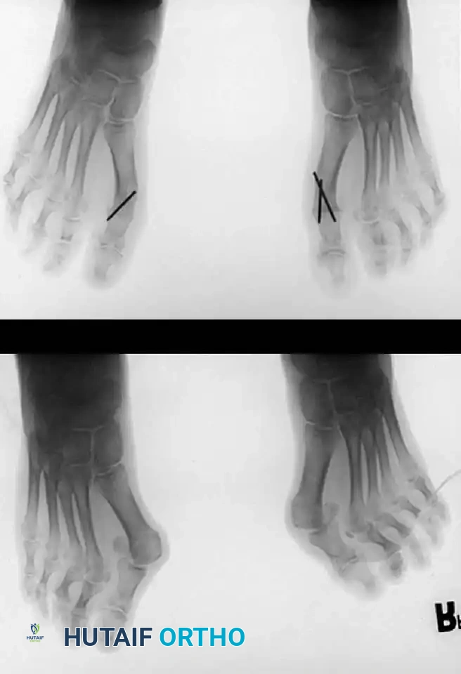 Disorders of the Hallux Surgical Diagram