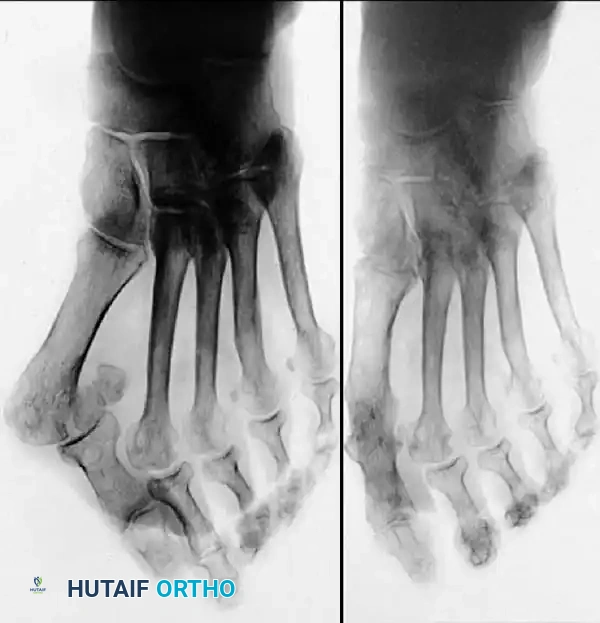 Disorders of the Hallux Surgical Diagram