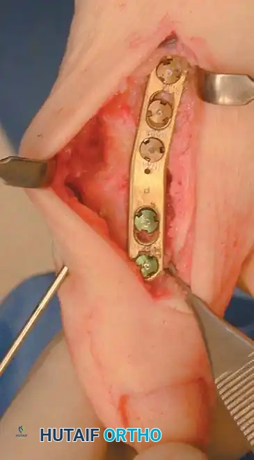 Fig. 78-56 Technique for arthrodesis of ﬁ rst metatarsophalangeal joint. A, Dorsal skin incision. B, Excision of metatarsal head. C, Fusion site placed in 15 to 20 degrees of valgus. D, Approximately 30 degrees of dorsiﬂ exion in relation to metatarsal shaft or approximately 10 to 15 degrees of dorsiﬂ exion in relation to ﬂ oor. E, Two parallel cuts are made. F, Six-hole, onequarter tubular plate in place. (From Mann RA, Coughlin MJ, eds: Surgery of the foot and ankle, 7th ed, St Louis, 1999, Mosby; C and D from Mann RA, Coughlin MJ: The video textbook of foot and ankle surgery , St Louis, 1991, Medical Video Productions.)