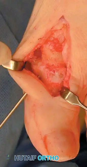 Fig. 78-56 Technique for arthrodesis of ﬁ rst metatarsophalangeal joint. A, Dorsal skin incision. B, Excision of metatarsal head. C, Fusion site placed in 15 to 20 degrees of valgus. D, Approximately 30 degrees of dorsiﬂ exion in relation to metatarsal shaft or approximately 10 to 15 degrees of dorsiﬂ exion in relation to ﬂ oor. E, Two parallel cuts are made. F, Six-hole, onequarter tubular plate in place. (From Mann RA, Coughlin MJ, eds: Surgery of the foot and ankle, 7th ed, St Louis, 1999, Mosby; C and D from Mann RA, Coughlin MJ: The video textbook of foot and ankle surgery , St Louis, 1991, Medical Video Productions.)