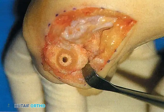 Fig. 78-57 Truncated cone arthrodesis. A, Preparation of phalangeal base with end-cutting reamer. B, Metatarsal angle guide for reaming. C, Cutting truncated cone with side-cutting reamer. D, Base of proximal phalanx after reaming. (From Johnson KA, ed: Master techniques in orthopaedic surgery: the foot and ankle , New York, 1994, Raven.)