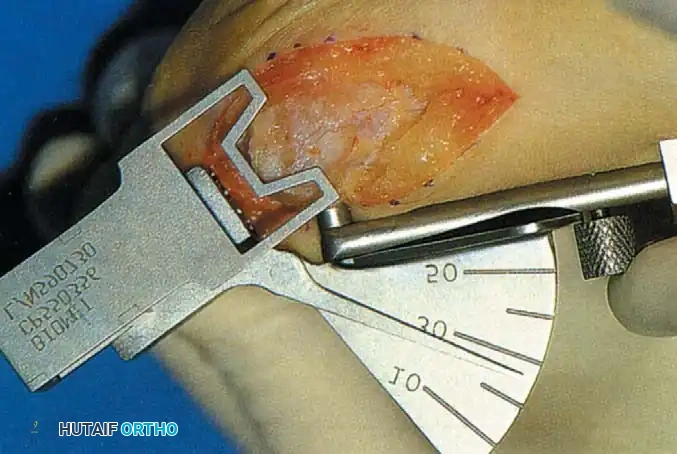 Fig. 78-57 Truncated cone arthrodesis. A, Preparation of phalangeal base with end-cutting reamer. B, Metatarsal angle guide for reaming. C, Cutting truncated cone with side-cutting reamer. D, Base of proximal phalanx after reaming. (From Johnson KA, ed: Master techniques in orthopaedic surgery: the foot and ankle , New York, 1994, Raven.)