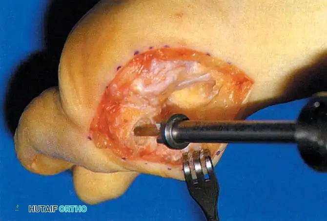 Disorders of the Hallux Surgical Diagram