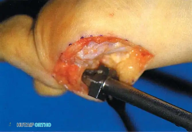 Fig. 78-57 Truncated cone arthrodesis. A, Preparation of phalangeal base with end-cutting reamer. B, Metatarsal angle guide for reaming. C, Cutting truncated cone with side-cutting reamer. D, Base of proximal phalanx after reaming. (From Johnson KA, ed: Master techniques in orthopaedic surgery: the foot and ankle , New York, 1994, Raven.)