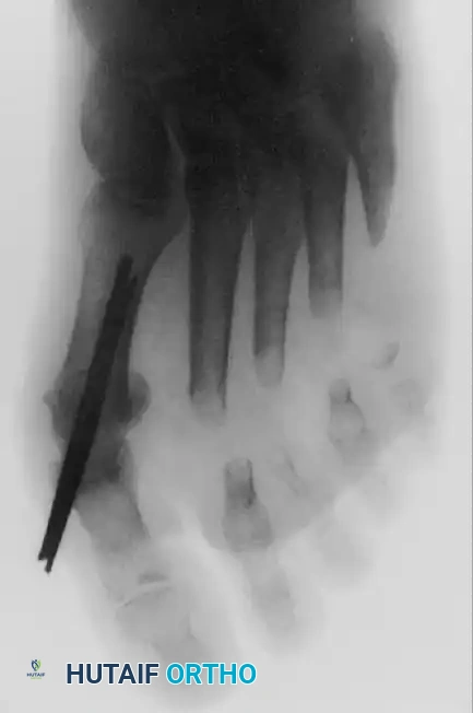 Fig. 78-58 Smith technique. (Courtesy of R.W. Smith, MD.)