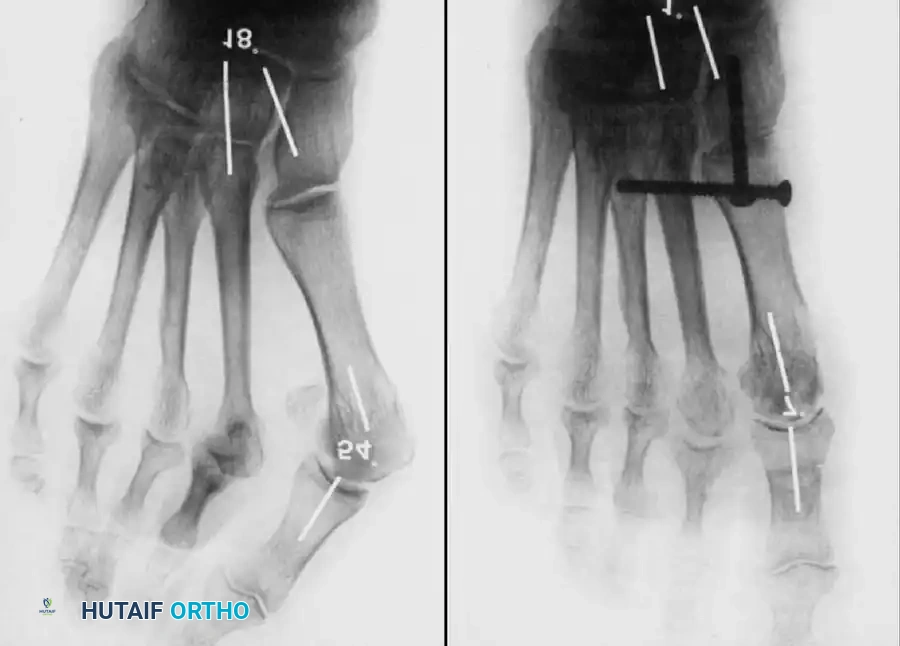 Disorders of the Hallux Surgical Diagram